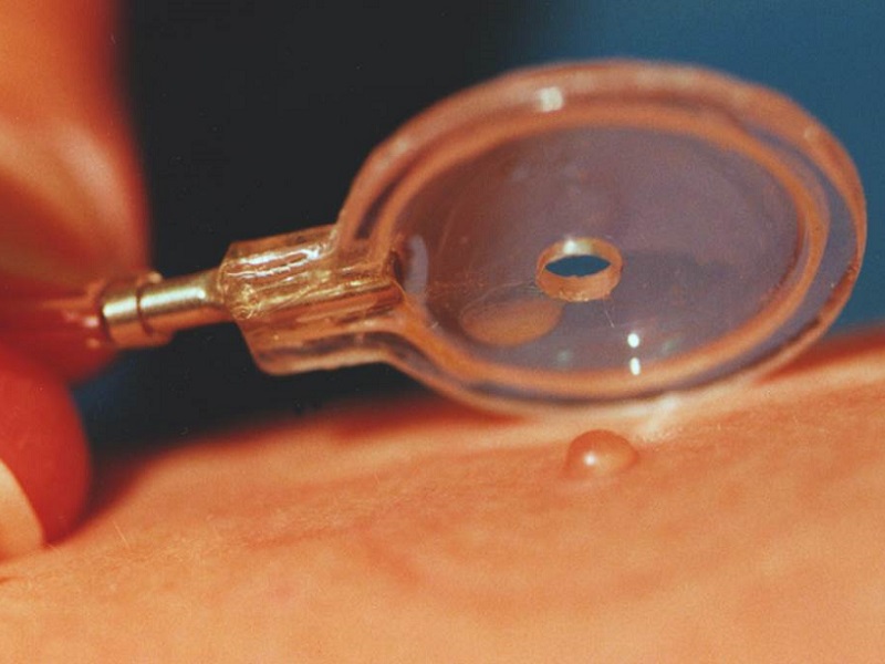 skin blister device close-up