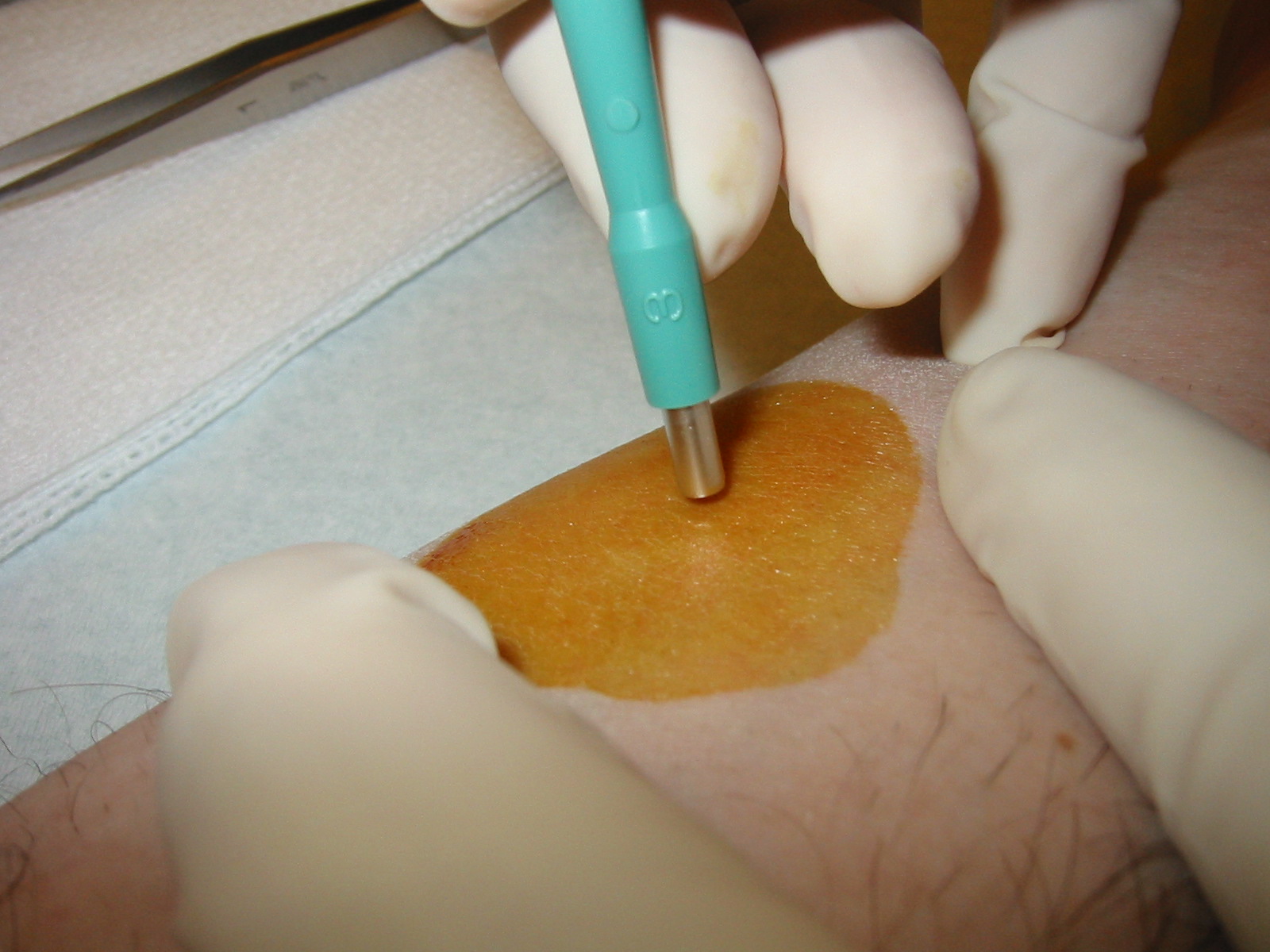 skin biopsy detail