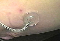 suction capsule is attached to skin